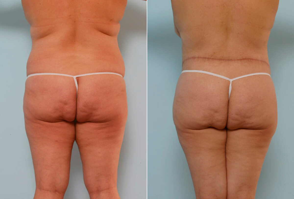 Body Lift before and after photos in Houston, TX, Patient 26842