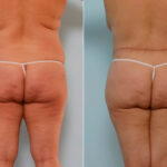 Body Lift before and after photos in Houston, TX, Patient 26842