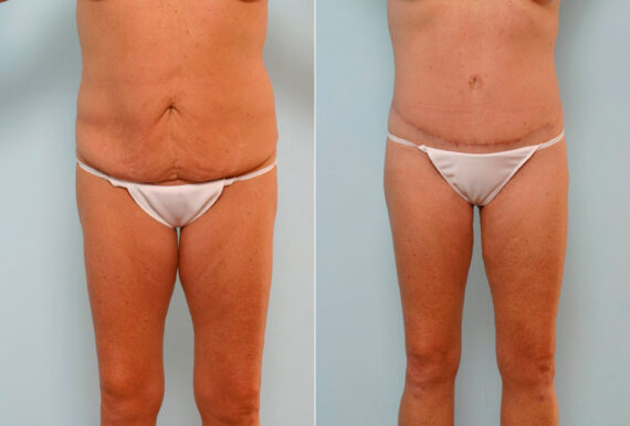 Body Lift before and after photos in Houston, TX, Patient 26851