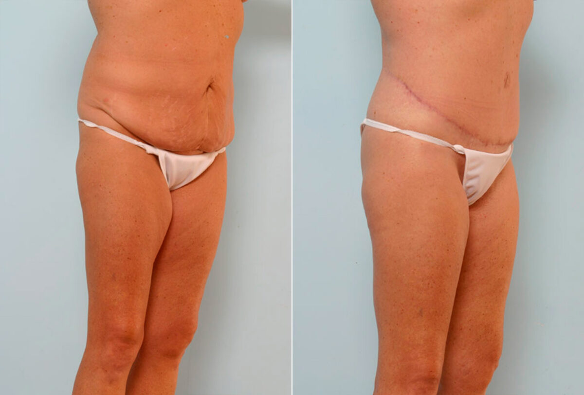 Body Lift before and after photos in Houston, TX, Patient 26851