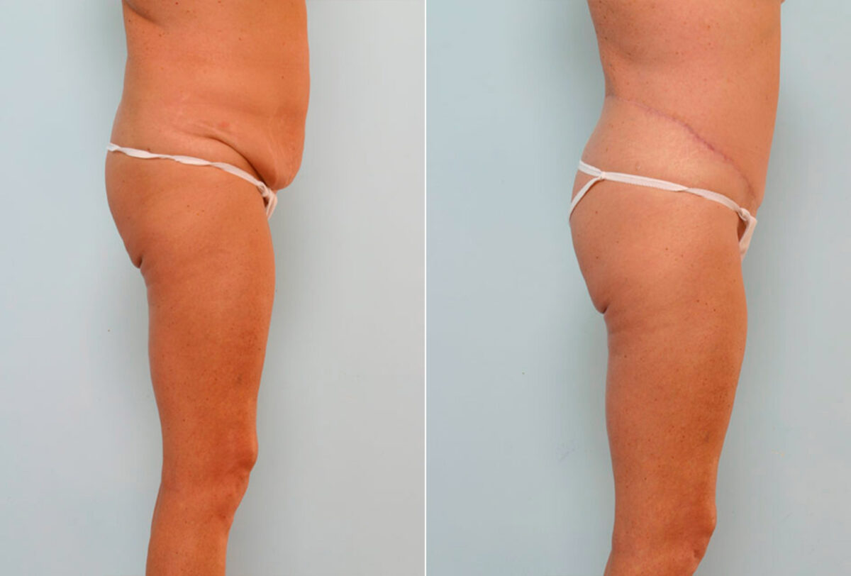 Body Lift before and after photos in Houston, TX, Patient 26851