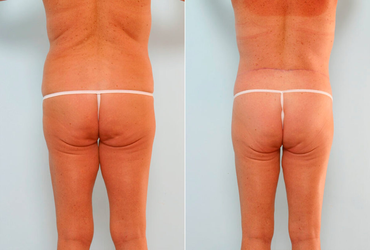 Body Lift before and after photos in Houston, TX, Patient 26851