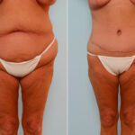 Body Lift before and after photos in Houston, TX, Patient 26869