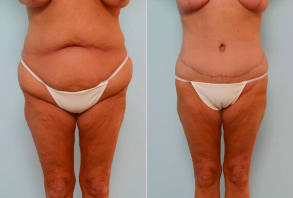 Body Lift before and after photos in Houston, TX, Patient 26869