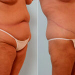 Body Lift before and after photos in Houston, TX, Patient 26869