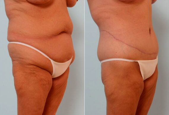 Body Lift before and after photos in Houston, TX, Patient 26869