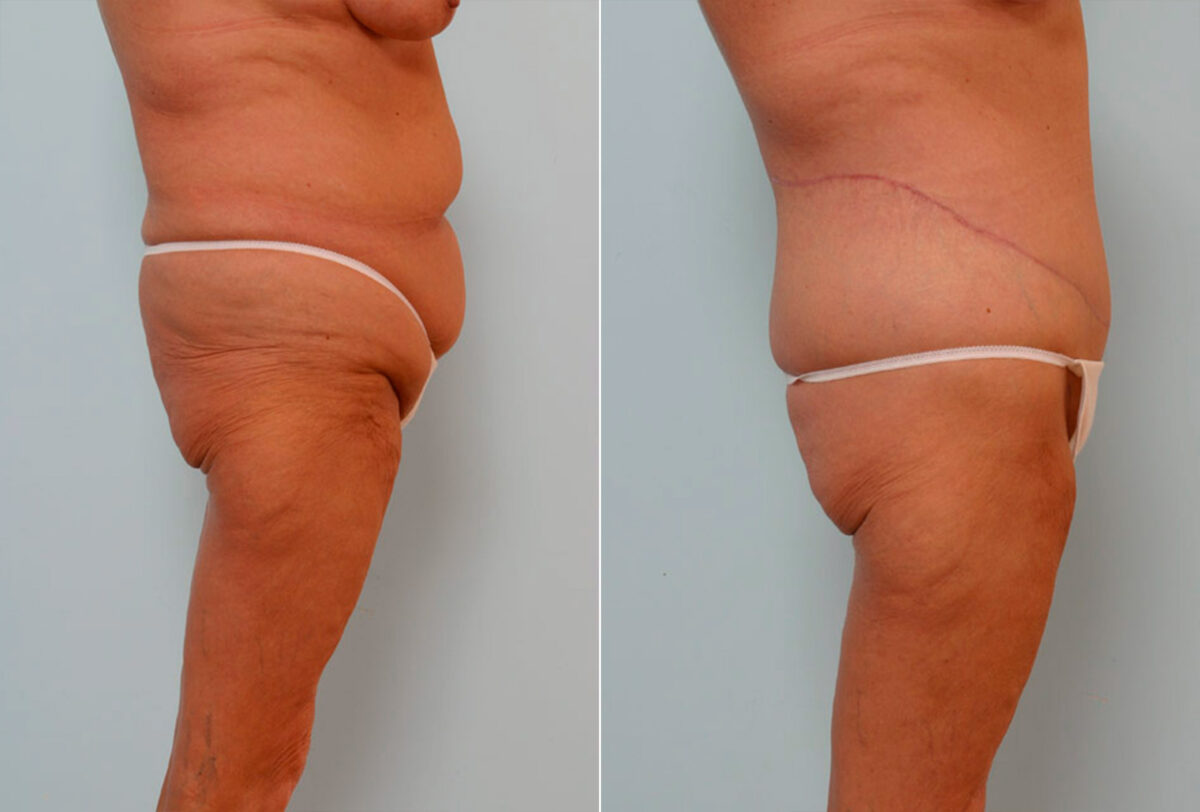 Body Lift before and after photos in Houston, TX, Patient 26869