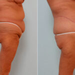 Body Lift before and after photos in Houston, TX, Patient 26869