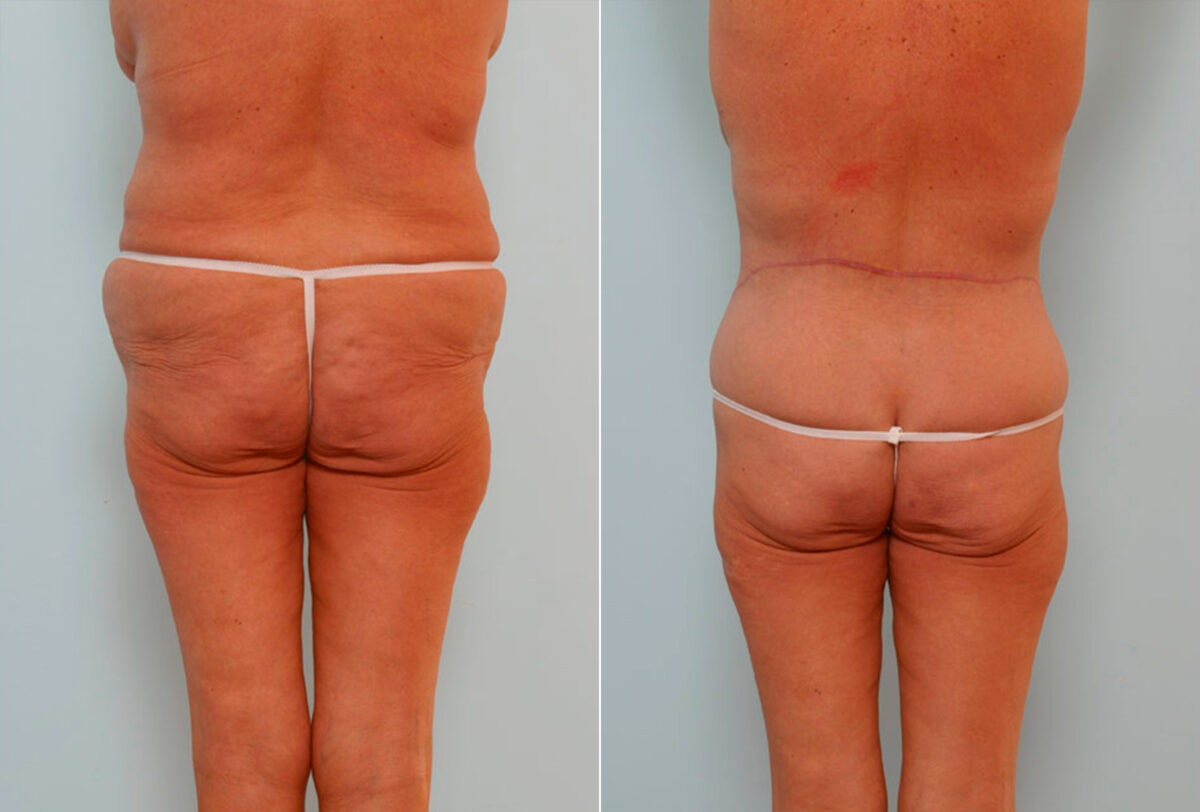 Body Lift before and after photos in Houston, TX, Patient 26869