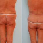 Body Lift before and after photos in Houston, TX, Patient 26869