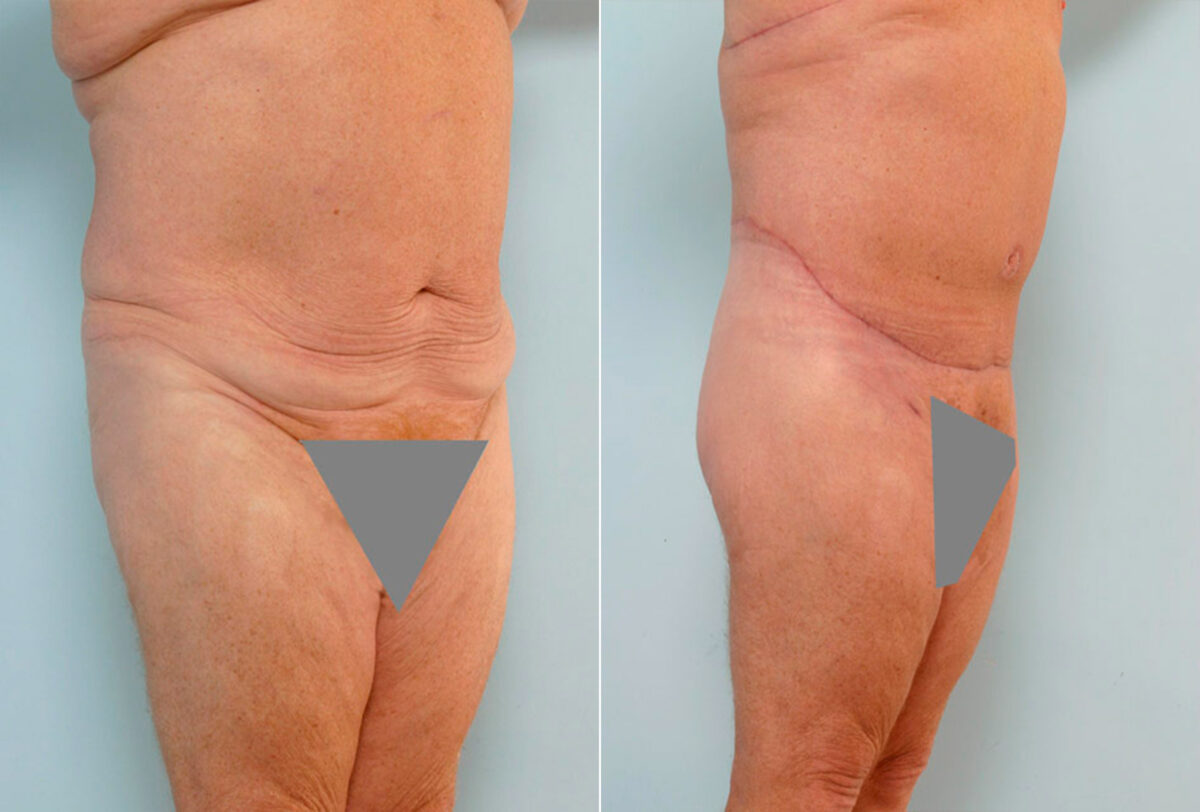Body Lift before and after photos in Houston, TX, Patient 26878
