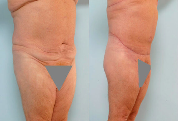 Body Lift before and after photos in Houston, TX, Patient 26878