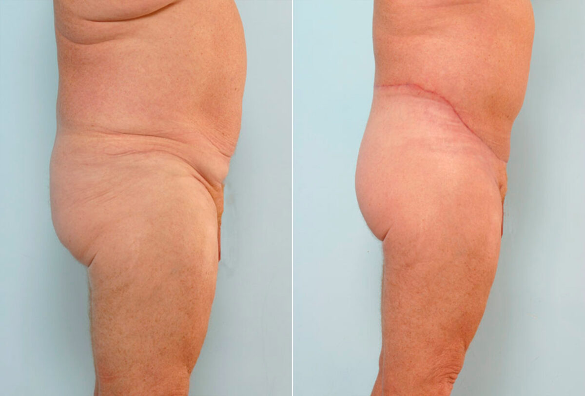 Body Lift before and after photos in Houston, TX, Patient 26878