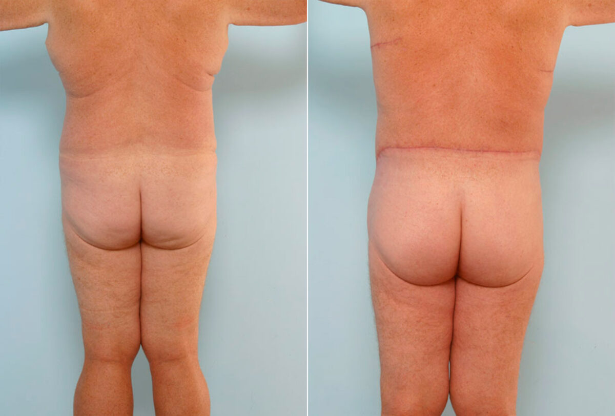 Body Lift before and after photos in Houston, TX, Patient 26878