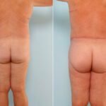 Body Lift before and after photos in Houston, TX, Patient 26878