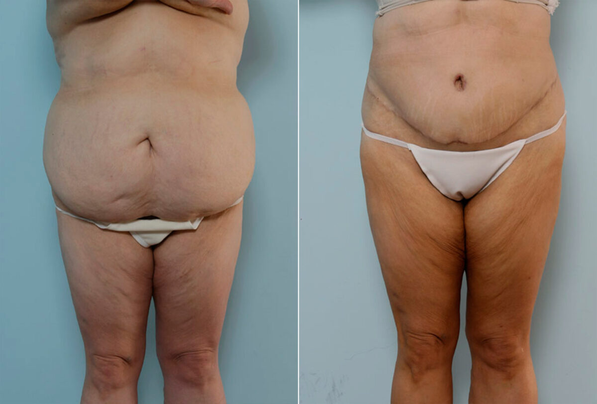 Body Lift before and after photos in Houston, TX, Patient 26905