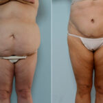 Body Lift before and after photos in Houston, TX, Patient 26905