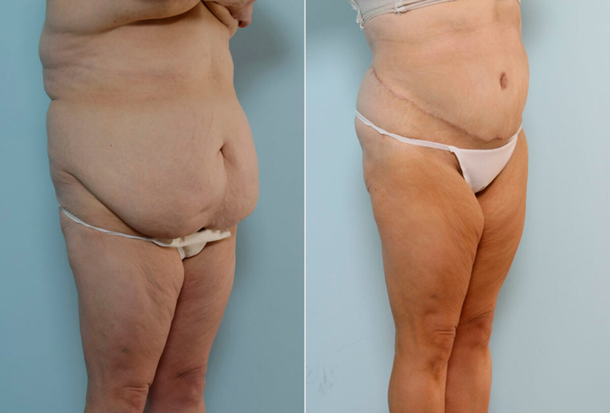 Body Lift before and after photos in Houston, TX, Patient 26905