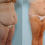 Body Lift before and after photos in Houston, TX, Patient 26905