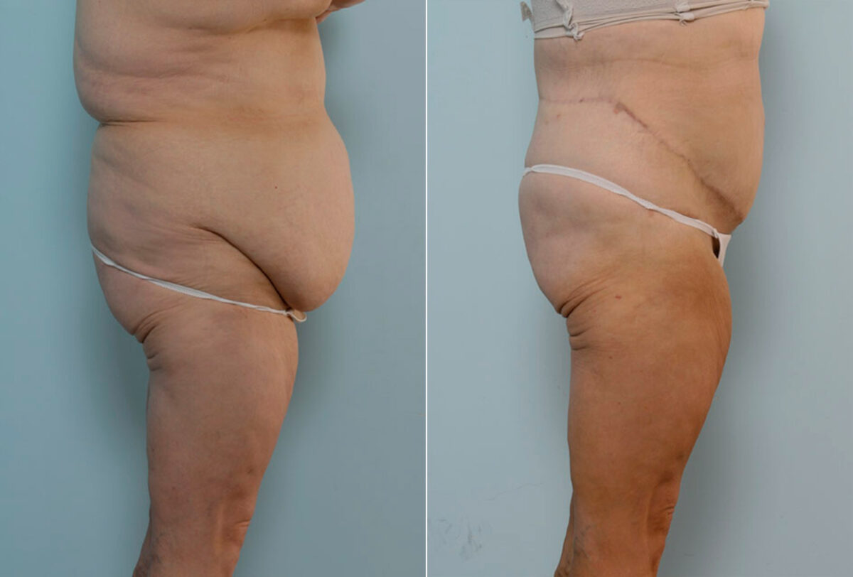 Body Lift before and after photos in Houston, TX, Patient 26905