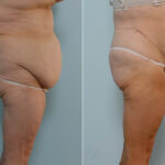 Body Lift before and after photos in Houston, TX, Patient 26905