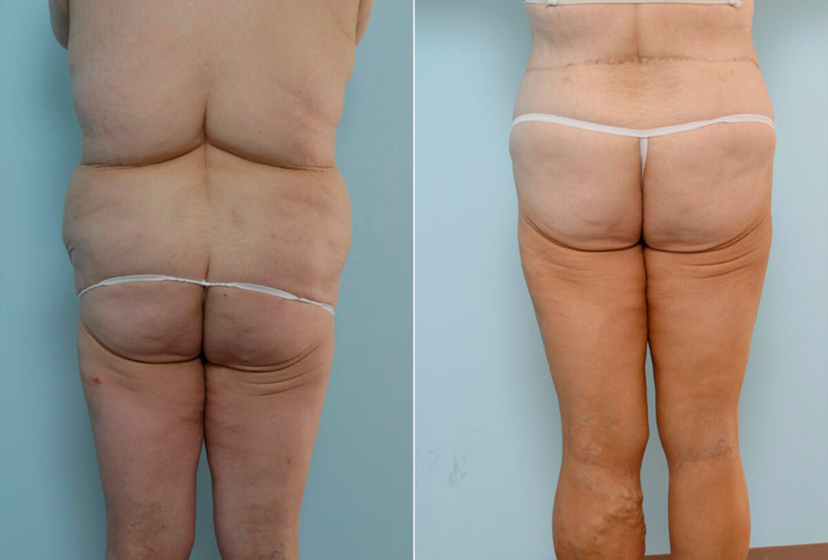 Body Lift before and after photos in Houston, TX, Patient 26905