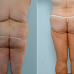 Body Lift before and after photos in Houston, TX, Patient 26905