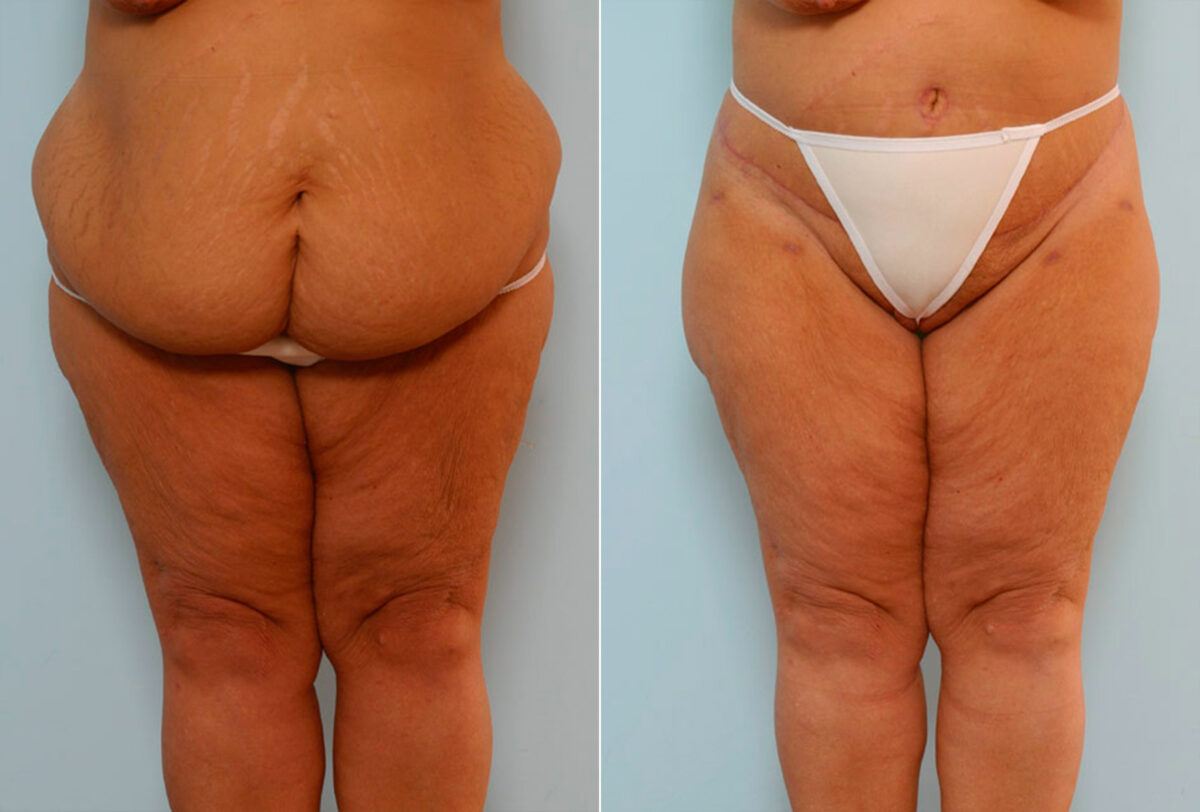 Body Lift before and after photos in Houston, TX, Patient 26932