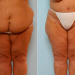 Body Lift before and after photos in Houston, TX, Patient 26932