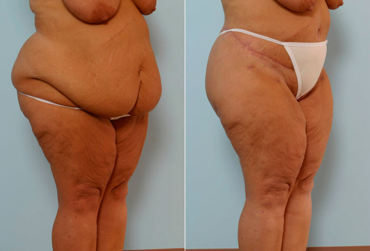 Body Lift before and after photos in Houston, TX, Patient 26932