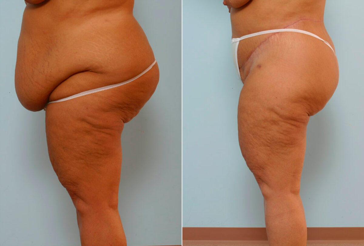 Body Lift before and after photos in Houston, TX, Patient 26932