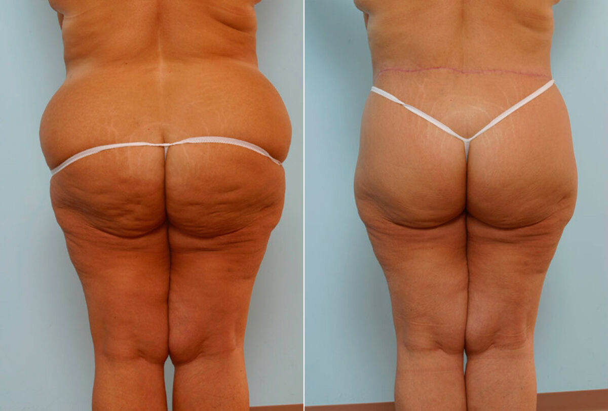 Body Lift before and after photos in Houston, TX, Patient 26932