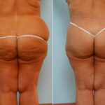 Body Lift before and after photos in Houston, TX, Patient 26932