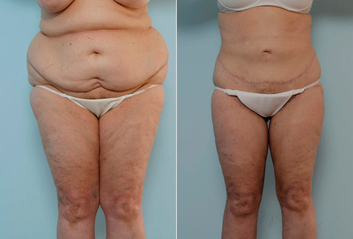 Body Lift before and after photos in Houston, TX, Patient 26941