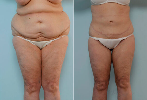 Body Lift before and after photos in Houston, TX, Patient 26941