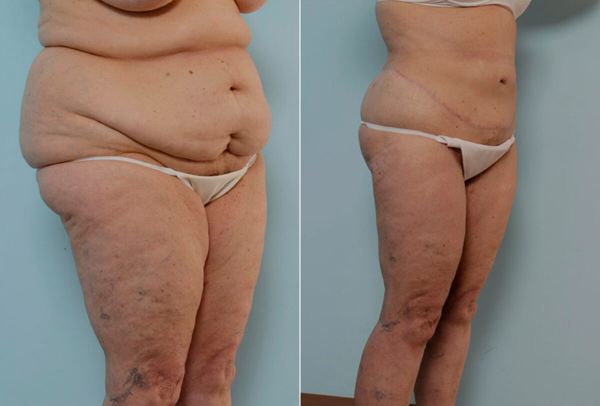 Body Lift before and after photos in Houston, TX, Patient 26941