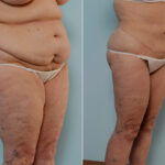 Body Lift before and after photos in Houston, TX, Patient 26941