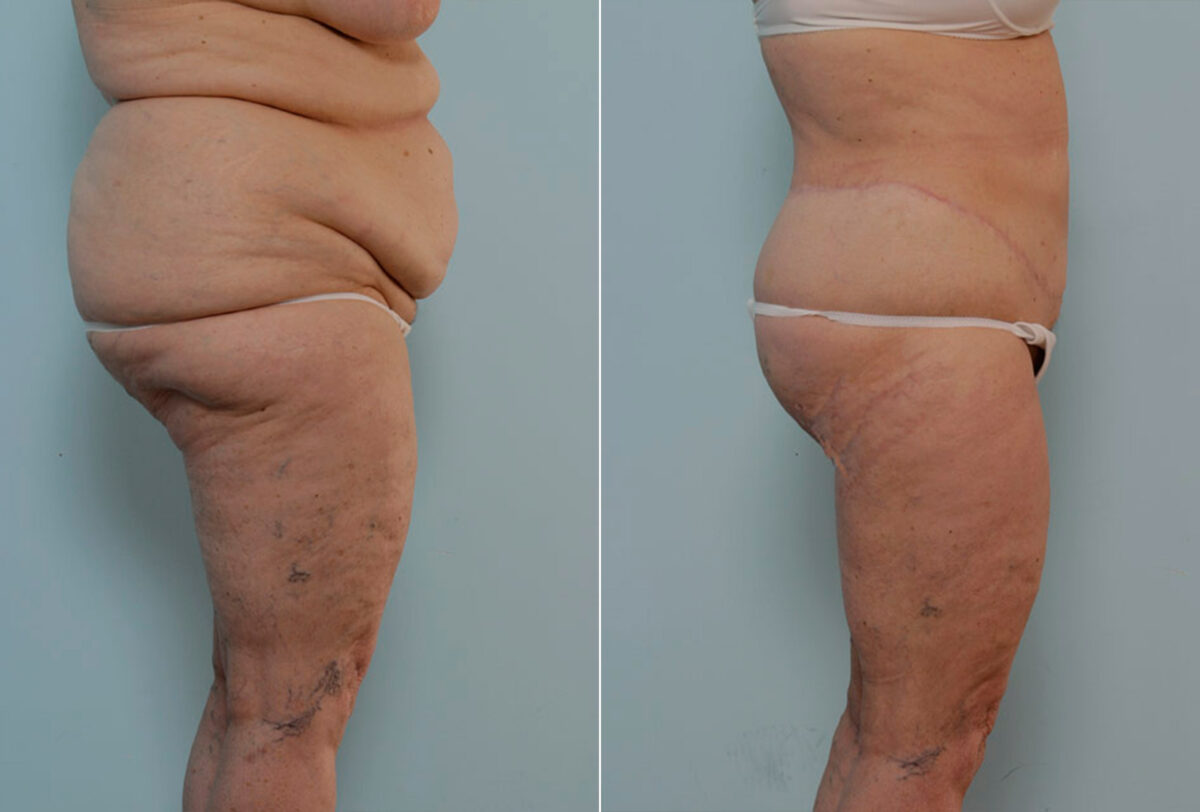 Body Lift before and after photos in Houston, TX, Patient 26941