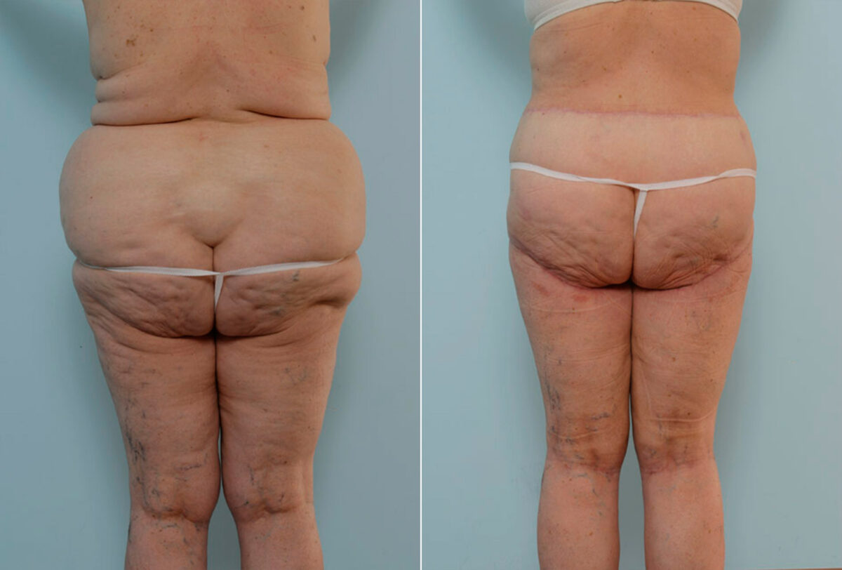 Body Lift before and after photos in Houston, TX, Patient 26941