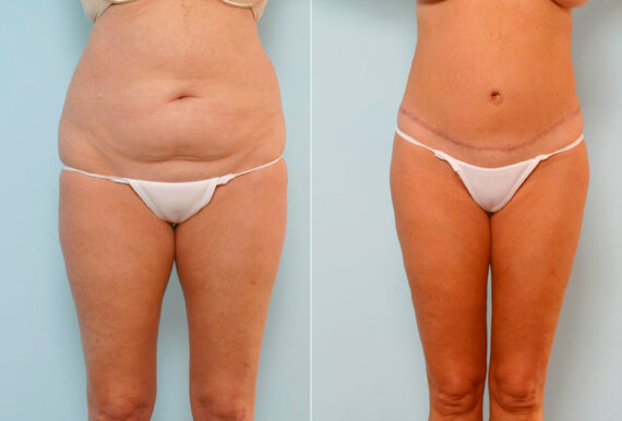 Body Lift before and after photos in Houston, TX, Patient 26950