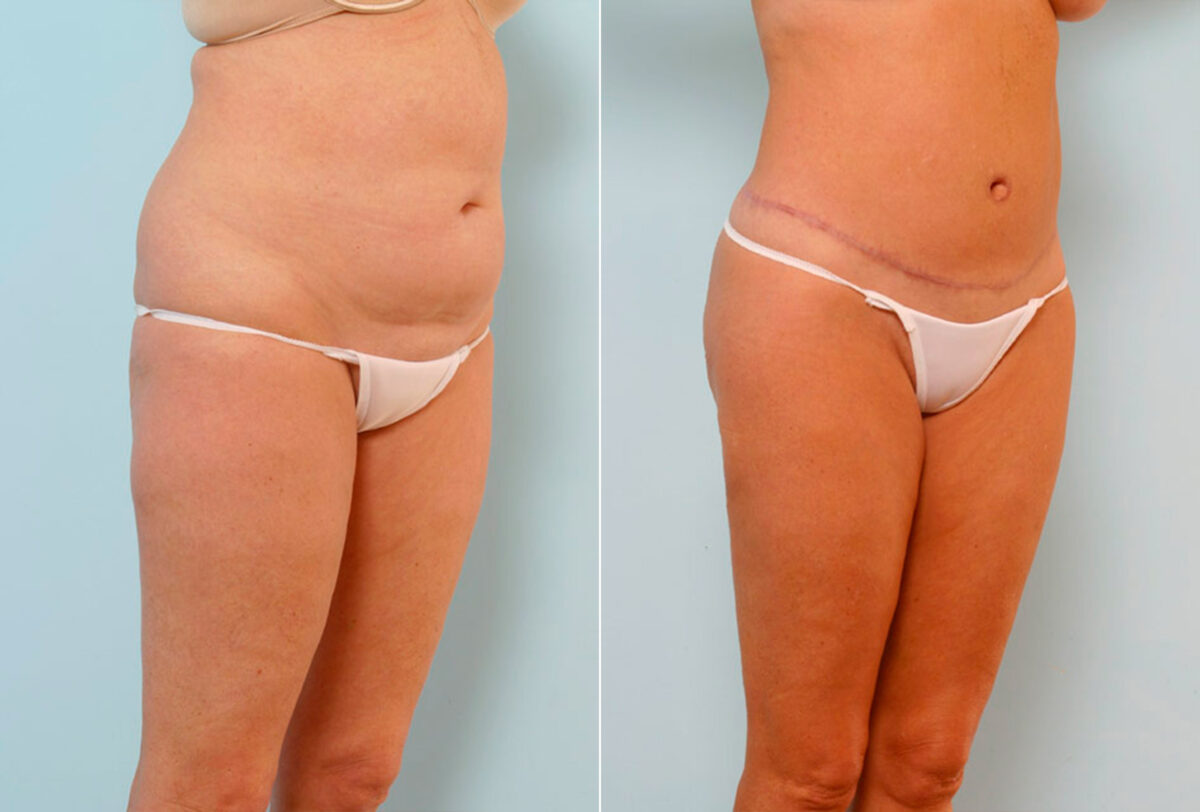 Body Lift before and after photos in Houston, TX, Patient 26950