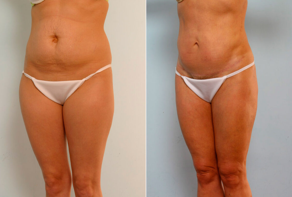 Tummy Tuck/Abdominoplasty before and after photos in Houston, TX, Patient 24219