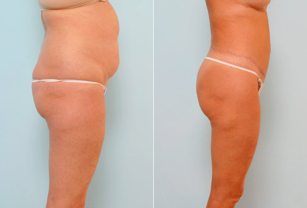 Body Lift before and after photos in Houston, TX, Patient 26950