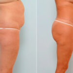 Body Lift before and after photos in Houston, TX, Patient 26950