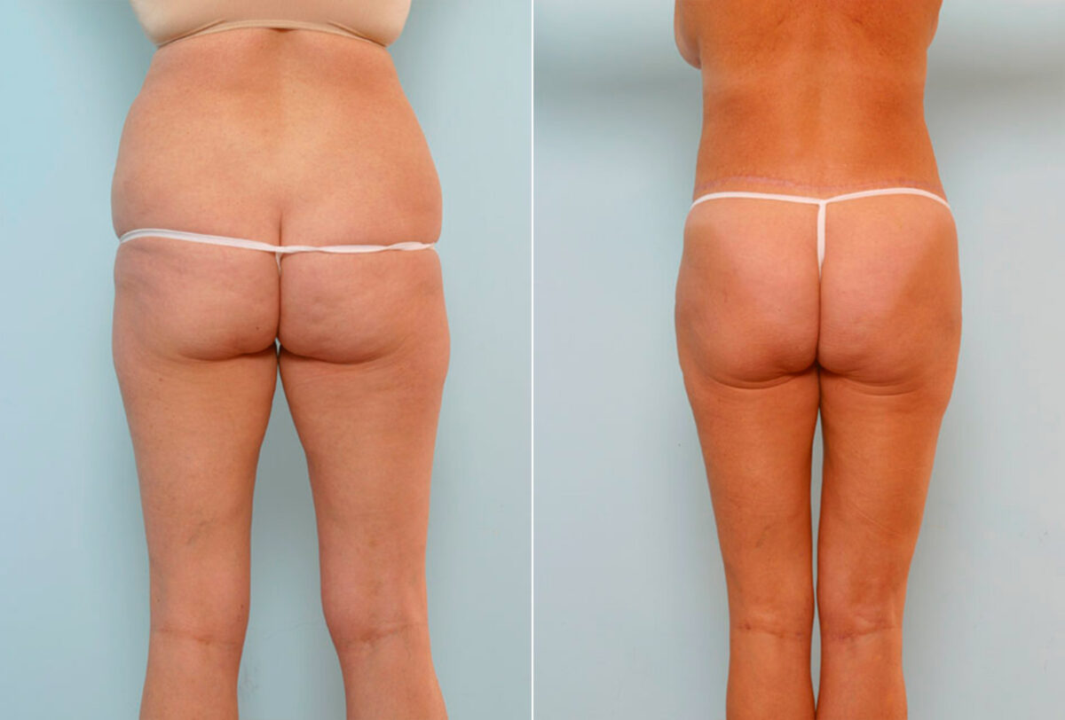 Body Lift before and after photos in Houston, TX, Patient 26950