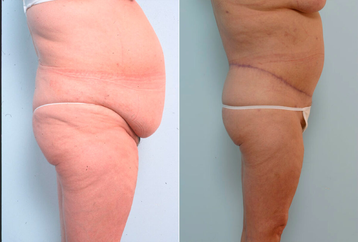 Body Lift before and after photos in Houston, TX, Patient 26959