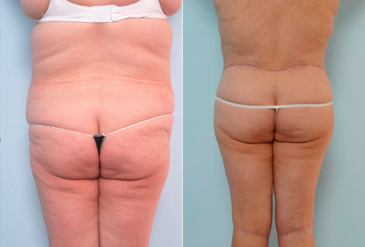 Body Lift before and after photos in Houston, TX, Patient 26959