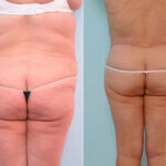 Body Lift before and after photos in Houston, TX, Patient 26959