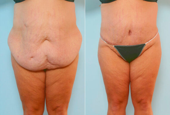 Body Lift before and after photos in Houston, TX, Patient 26968