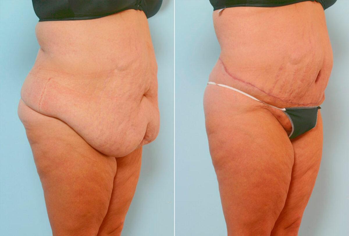 Body Lift before and after photos in Houston, TX, Patient 26968